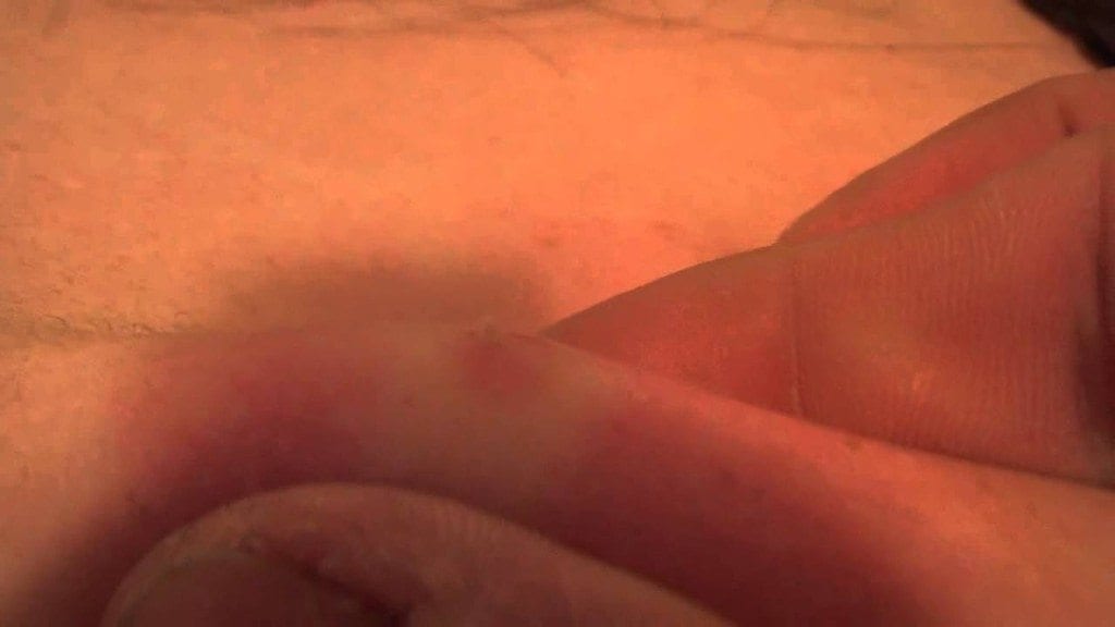 Pimple Pop Surprise 1