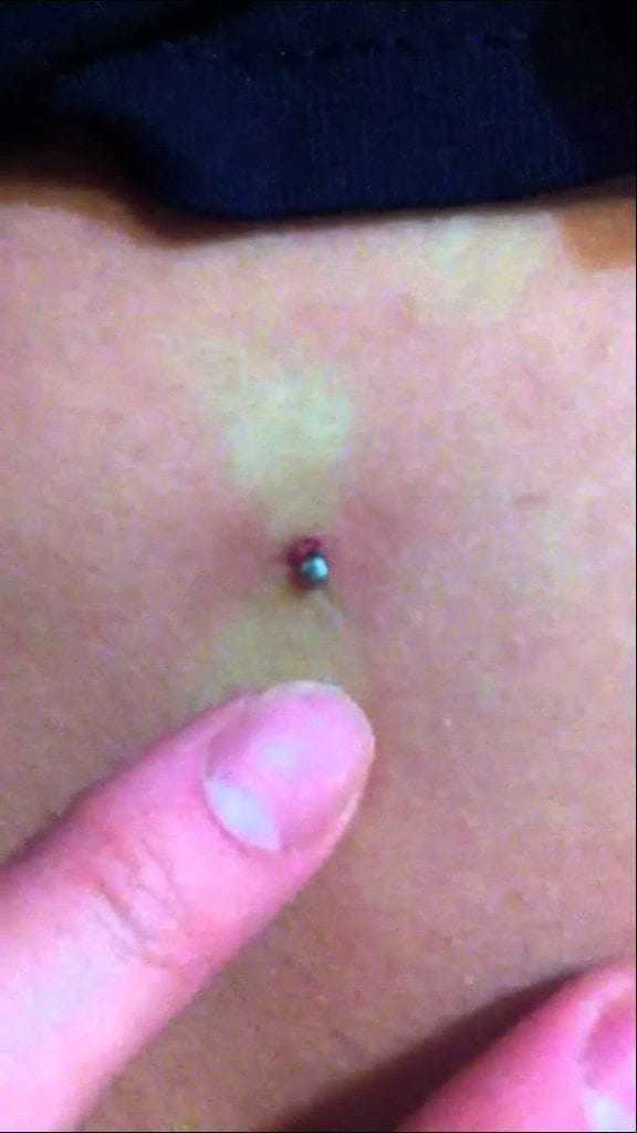 Sweet Little Bacne Blackhead! 1
