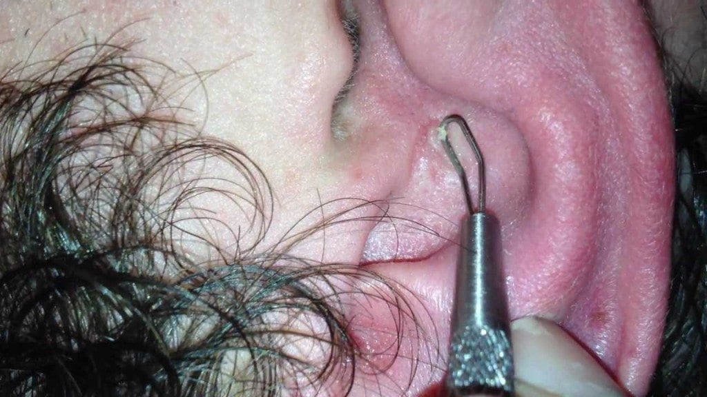 The Best Ear Blackhead!! 1