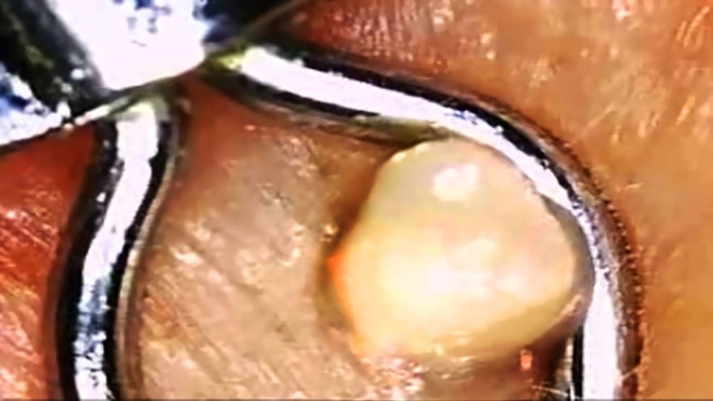 Zit Under the Microscope 1