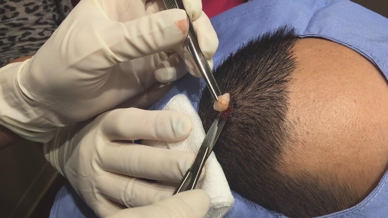 Cyst and Blackhead 1 Cyst and Blackhead 1