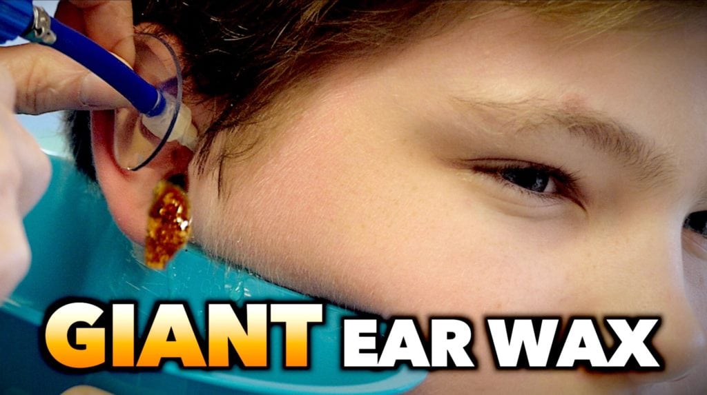 Earwax with Dr. Paul 1