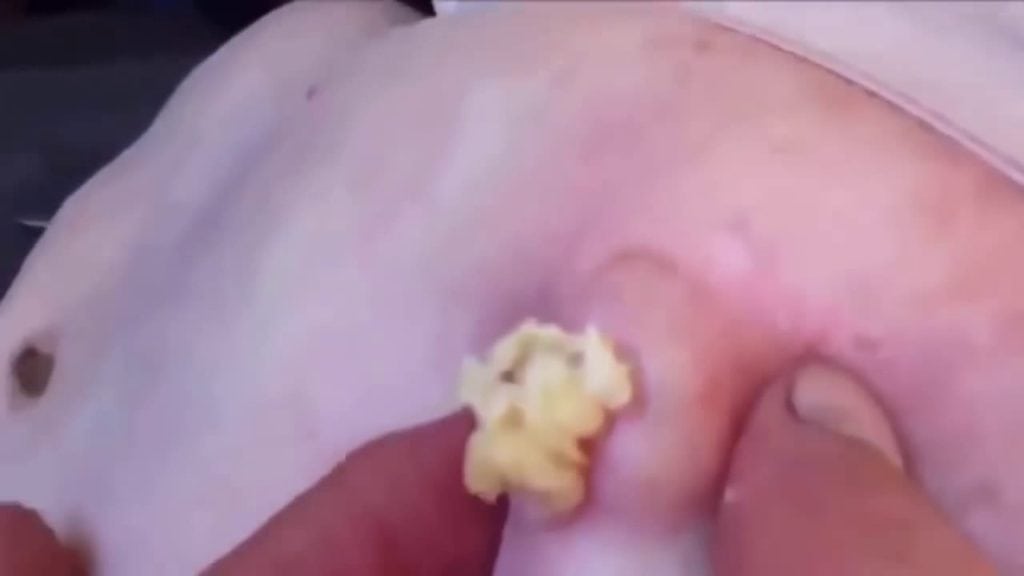 Not a Blackhead 2 Not a Blackhead 1
