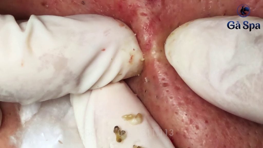 Big Fat Blackheads for your Viewing Pleasure. 1