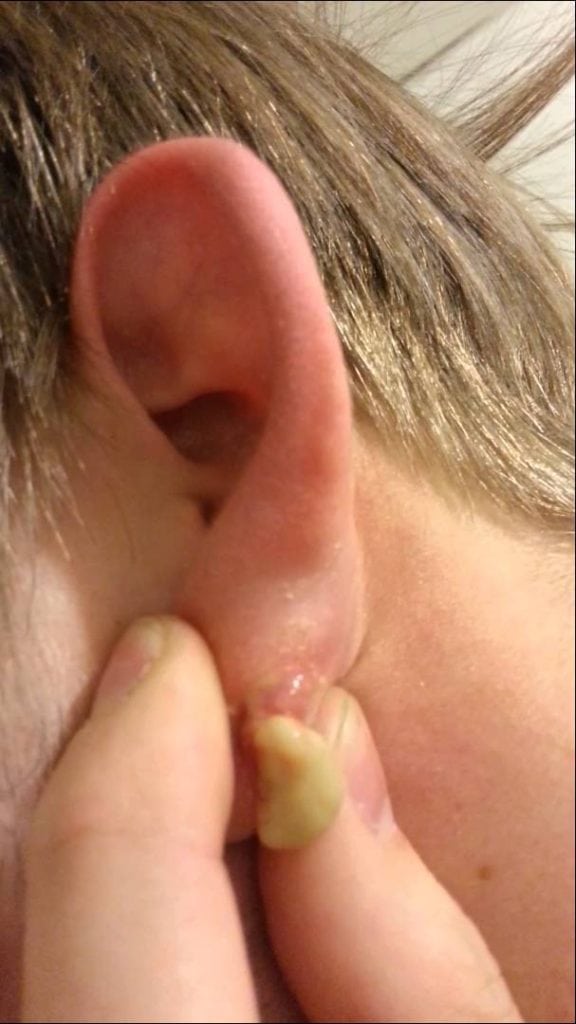 Ear Zit 2 Ear Zit 1