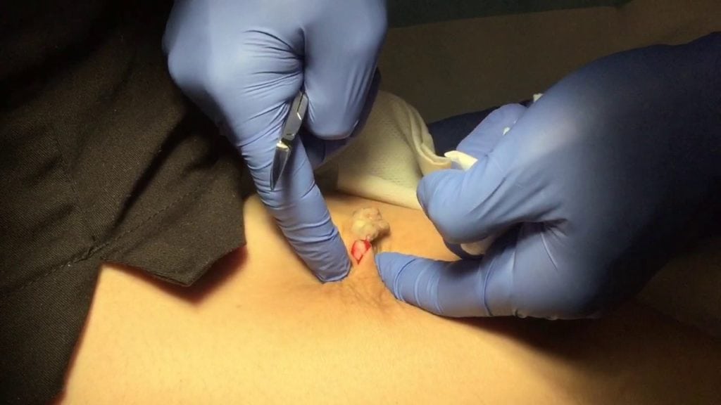 20 year old Cyst 1