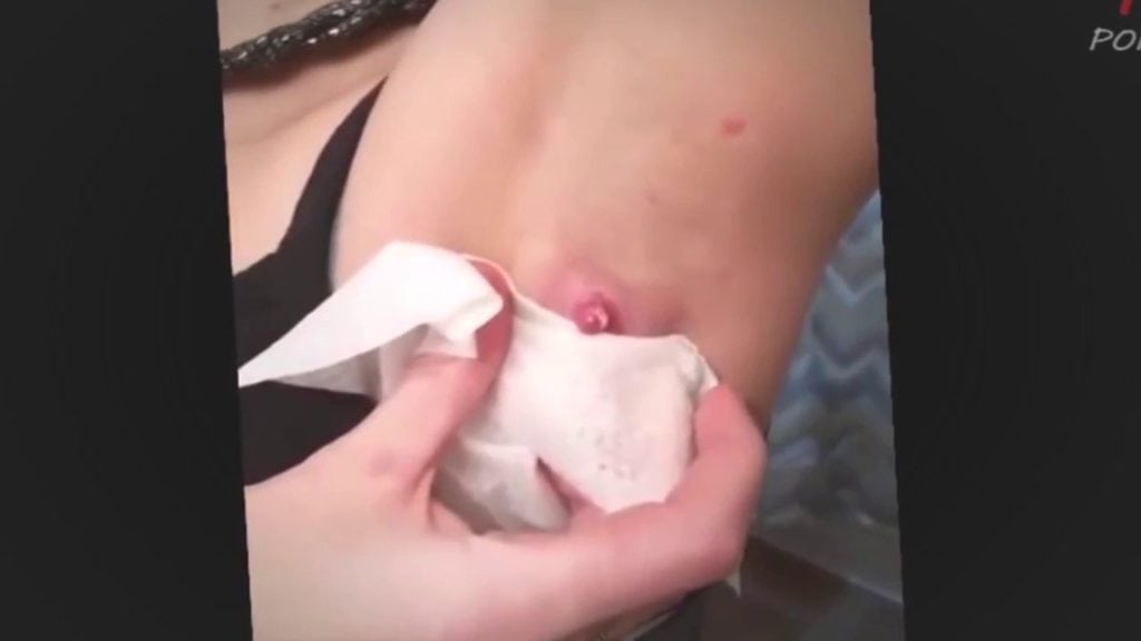 Armpit Zit 2 Armpit Zit 1