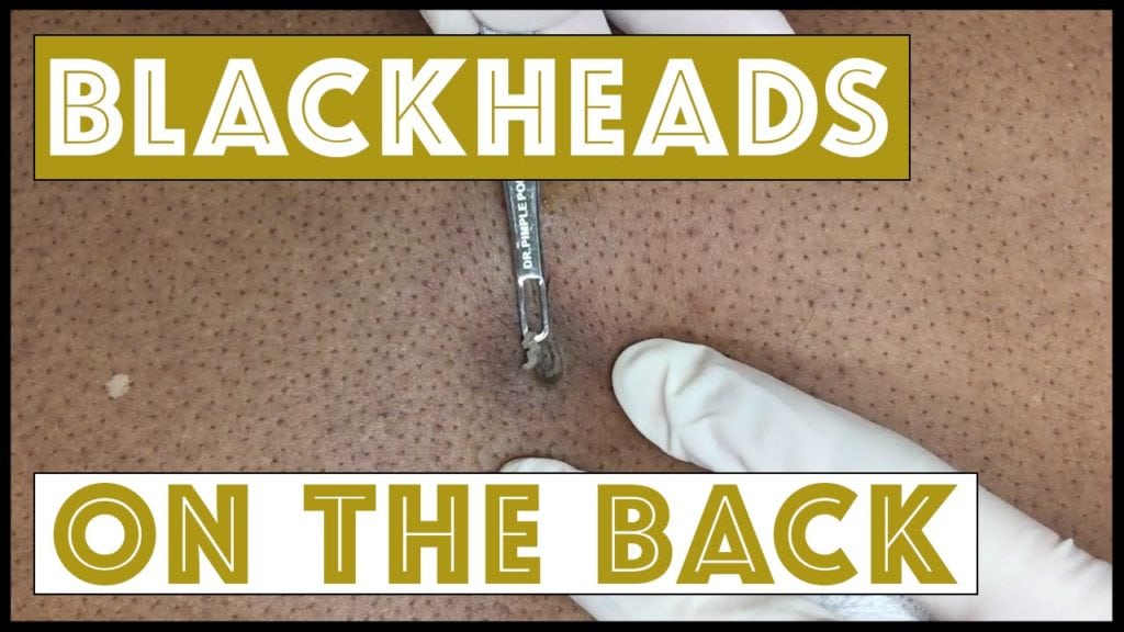 Back Blackheads 1