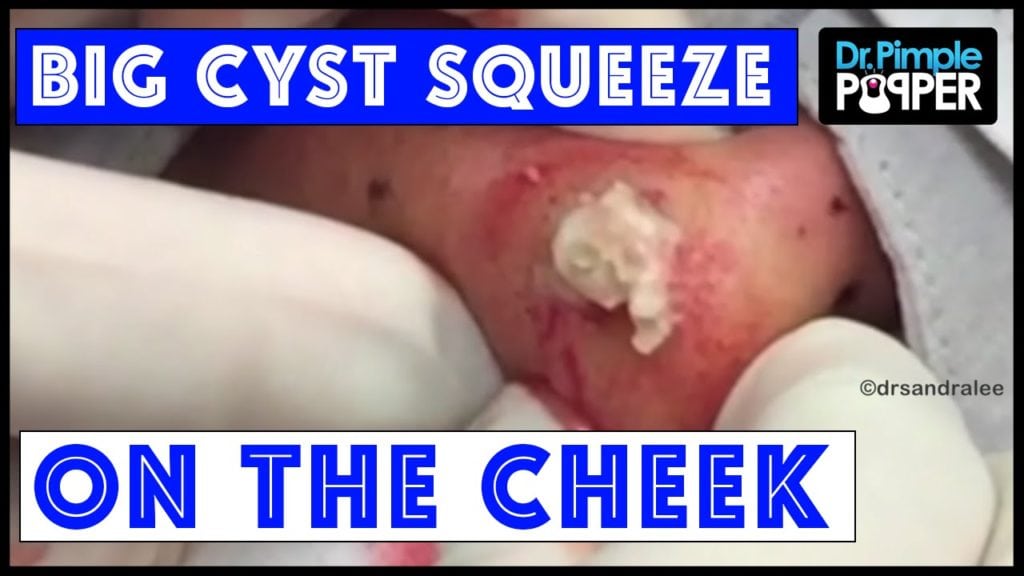Big Cyst Squeeze 1