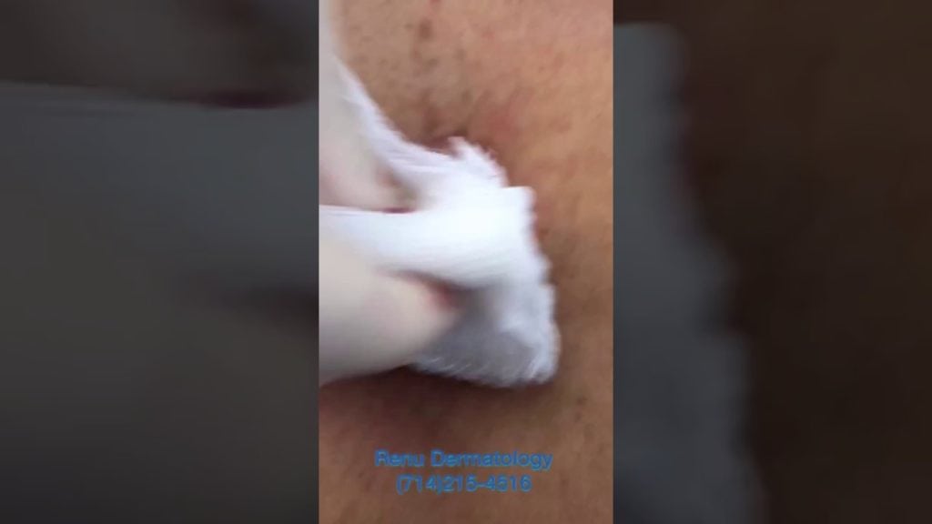 Biggest Cyst on the Internet 1