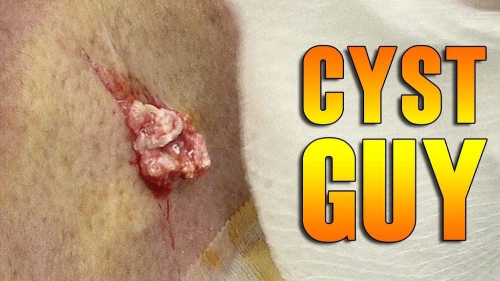 Cyst Guy 2 Cyst Guy 1