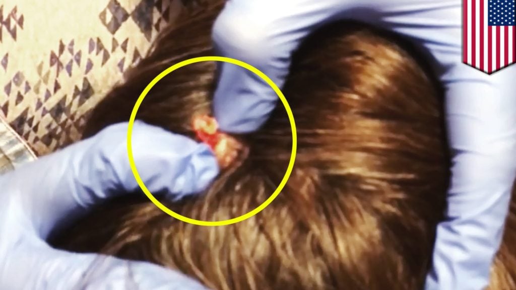 Cyst on Head 1