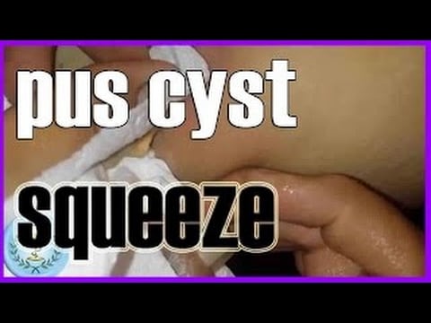 Infection with Pus 1