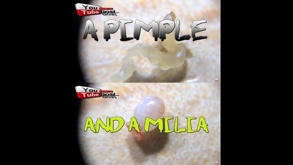 A Blackhead A Pimple and a Milia 1