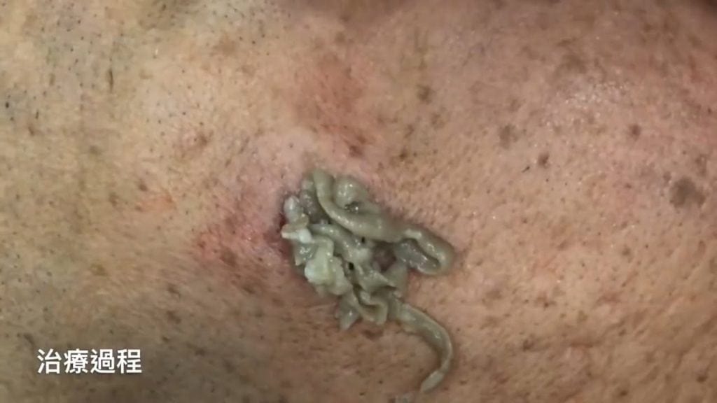 "Big Infected Cystic Acne Removal on Face" 1