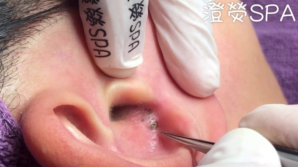 Holey blackheads, Batman 1