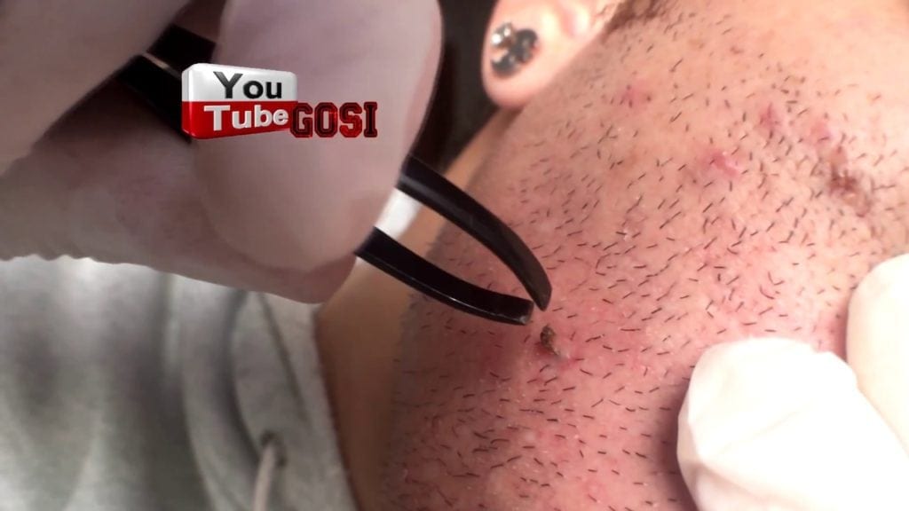 Perfect Mix of Popping and Plucking, Blackhead with and Ingrown hair with in it 4K 1