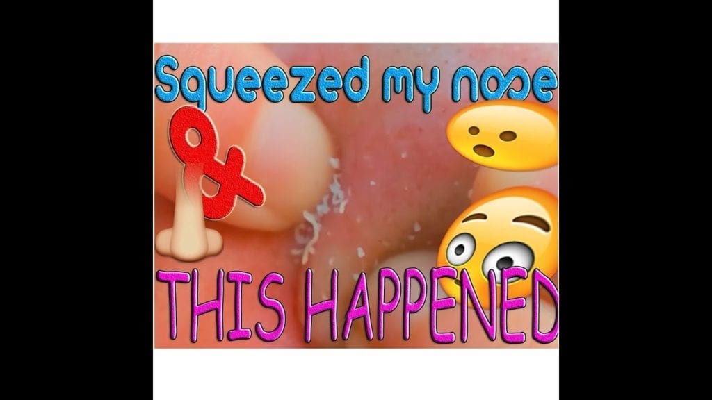 Cheesy nose 1