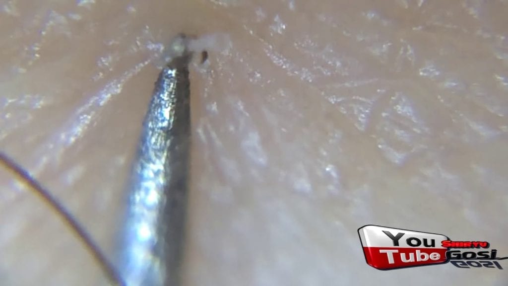 halloween ingrown hair extraction 1 1