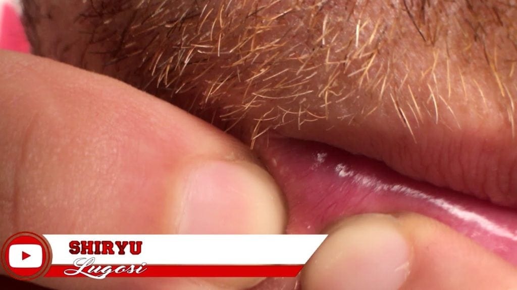 Lip Blackheads Popping 1