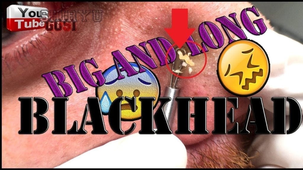 Nose Blackhead and Some Others 1