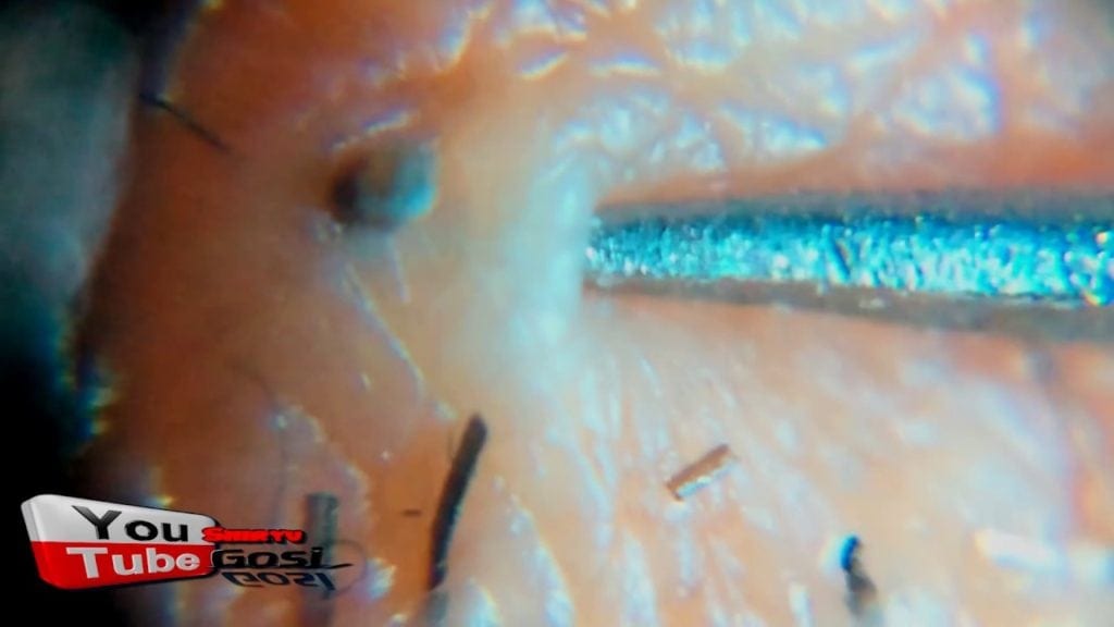 Pore Of Winer Extraction 1