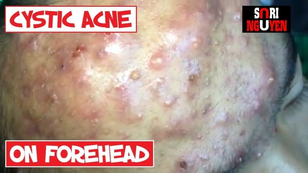 A very cystic forehead - pocket of plugs 2 A very cystic forehead - pocket of plugs 1