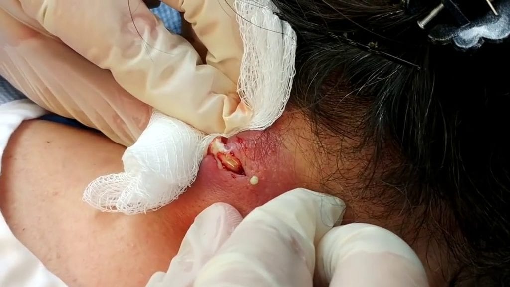 Big infected neck cyst 1