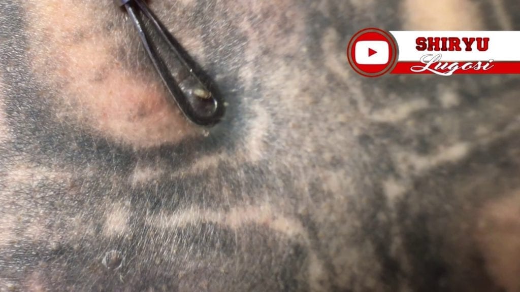 Blackhead getting popped 1