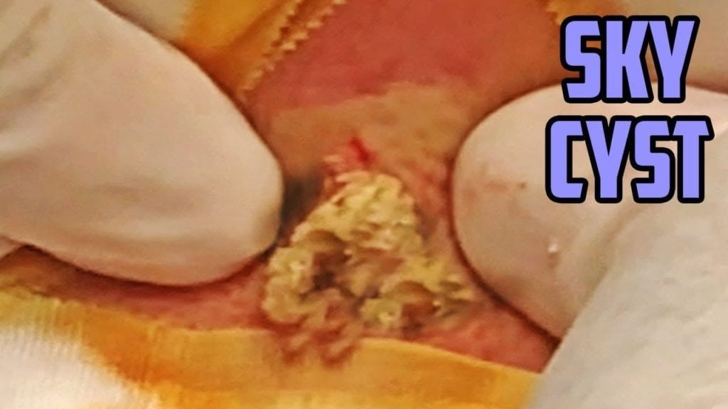 Cyst Bursting 1