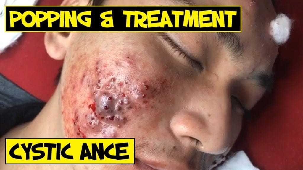 Cystic Acne and Side Effects 2 Cystic Acne and Side Effects 1