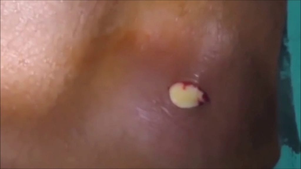 Huge amount of pus drained from abscess. 1