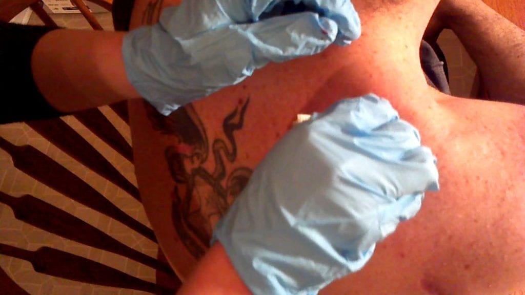 Lancing a Sebeceous Cyst 1