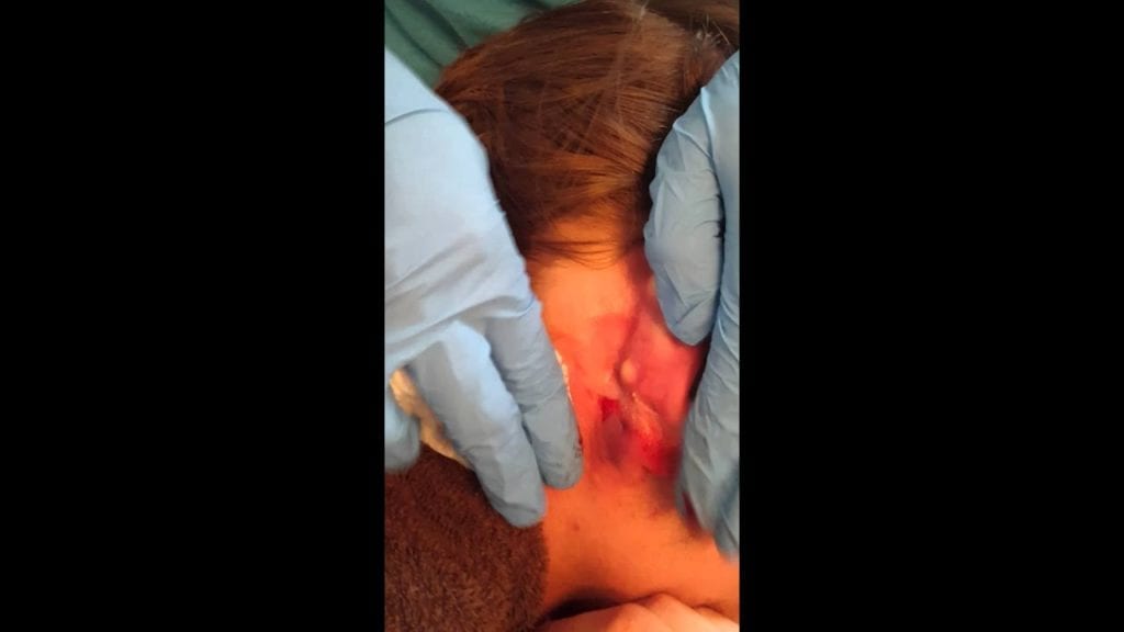 Giant, gunk filled sack behind the ear. 1