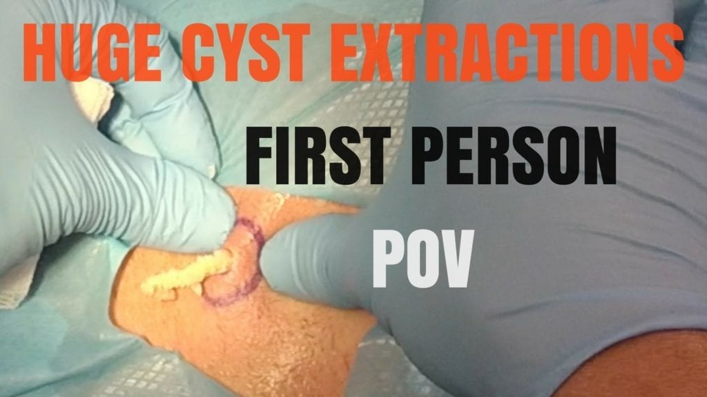 POV Cyst 1