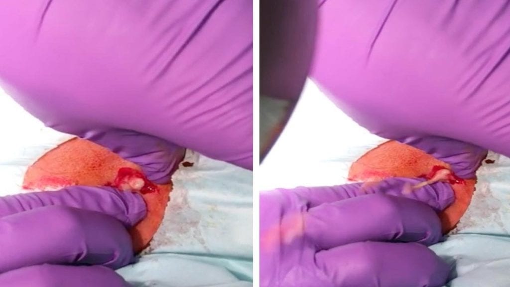 Cyst Blast 1