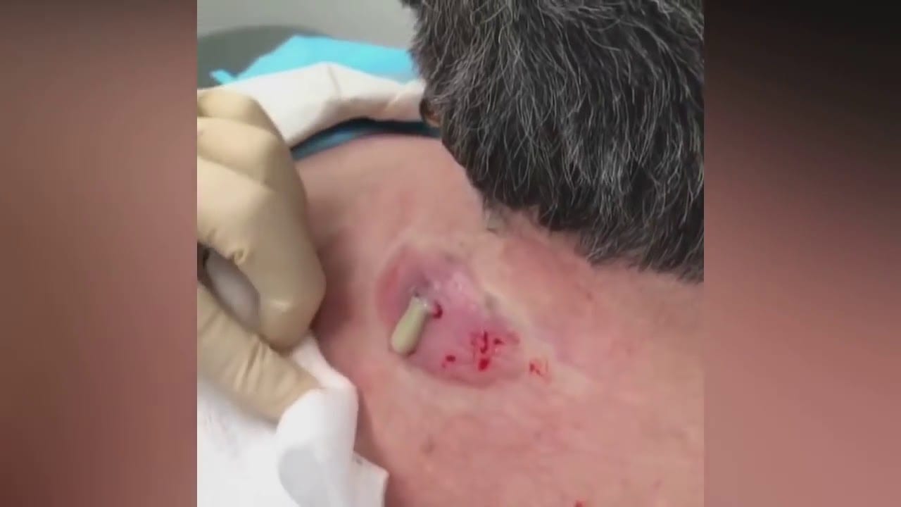 Cyst Extraction Popping Blackheads and Cyst 3