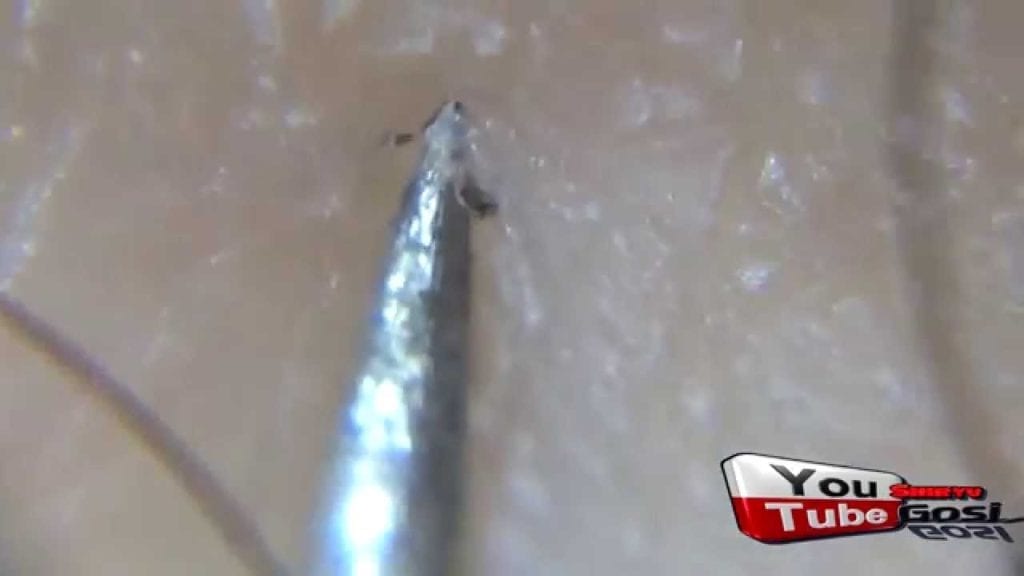 Ingrown hair extraction close up 1