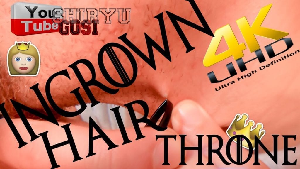 Pulling an ingrown hair 1