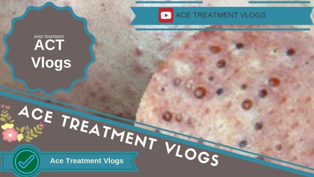 Relaxing acne treatment 1
