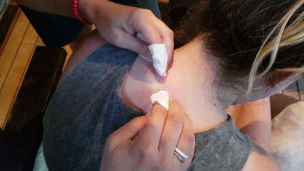 Big Blackhead 1