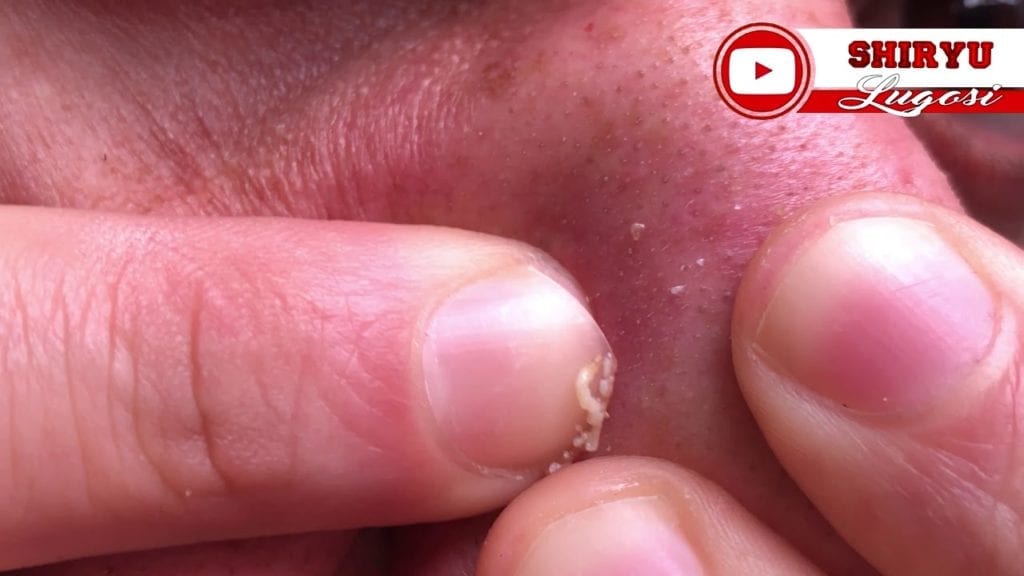 Big Nose Blackhead 4K 60FPS #Popping 1