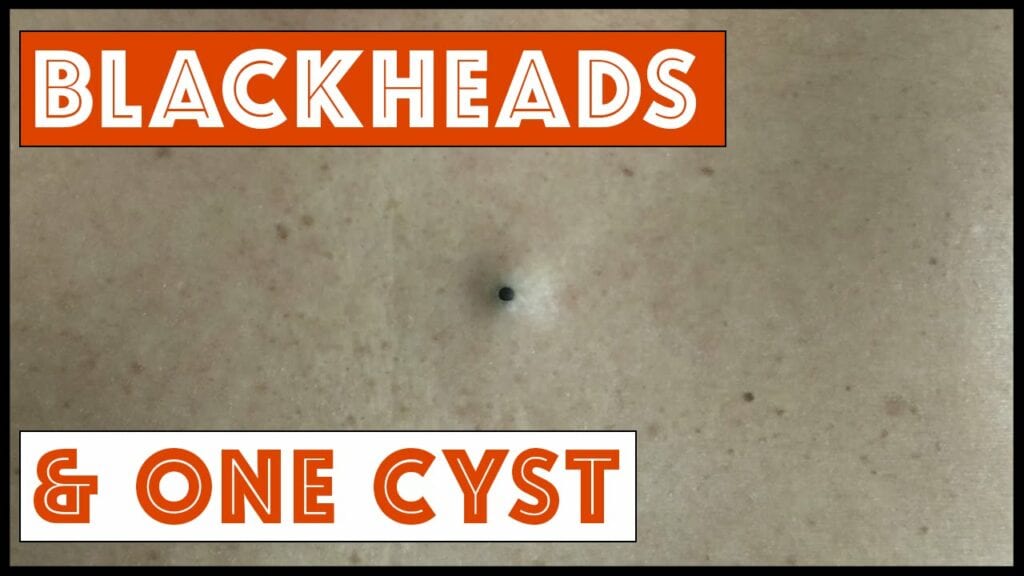 Blackheads and one cyst 1