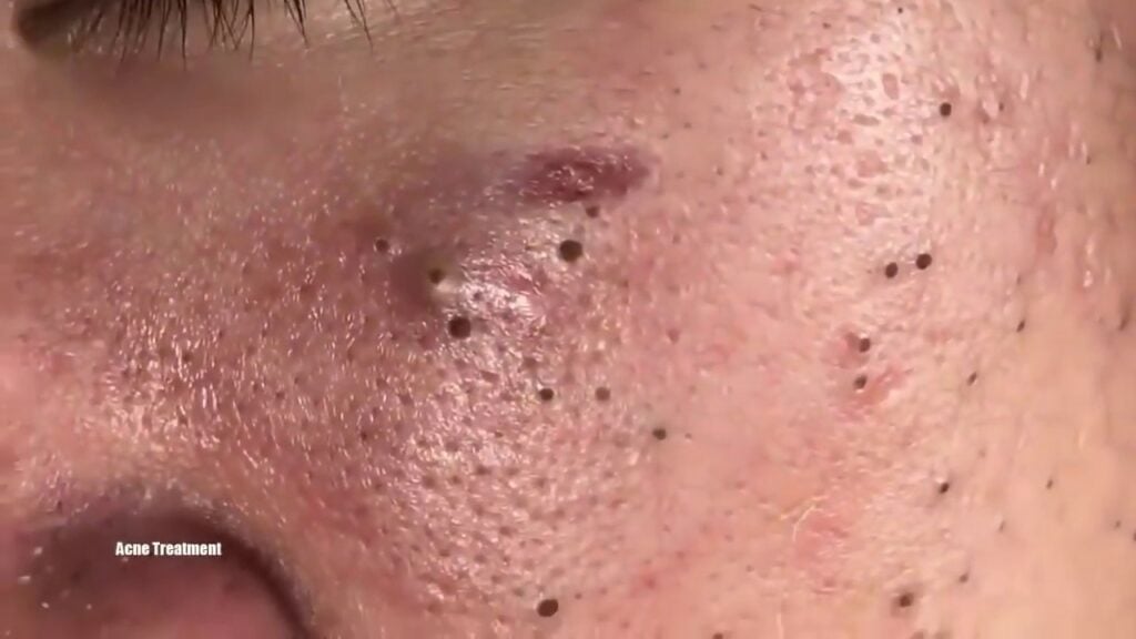 Blackheads - poking and squeezing 1 Blackheads - poking and squeezing 1