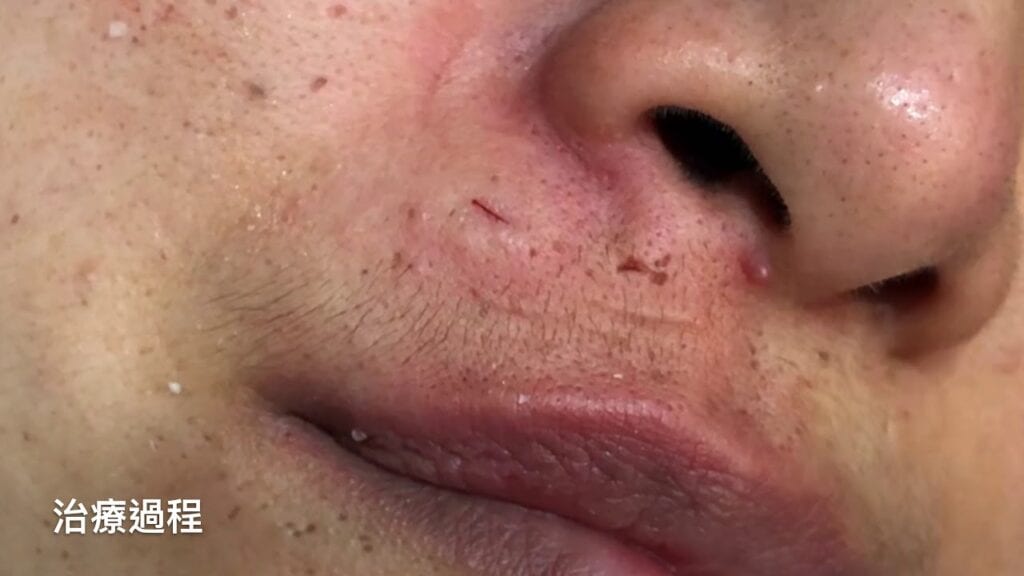 The Lip Cyst that Keeps On Giving 1