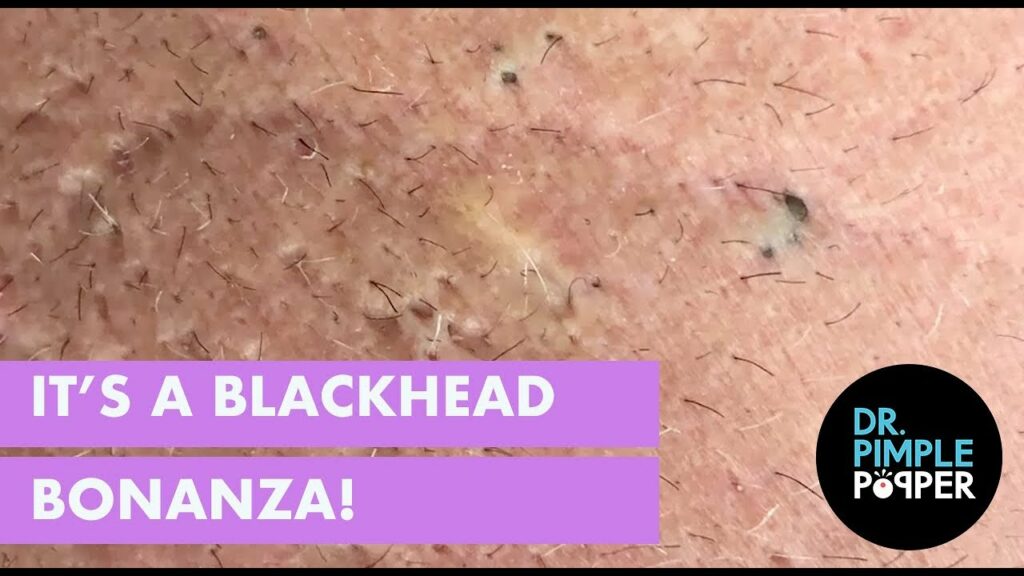 Blackheads galore 1 Blackheads galore 1