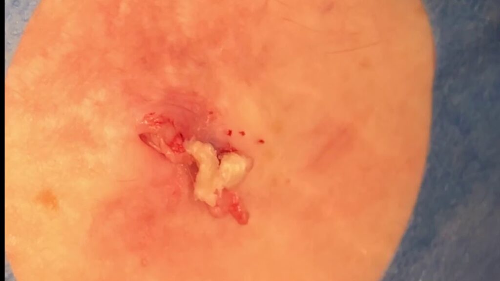 Cleaning out a cyst 1