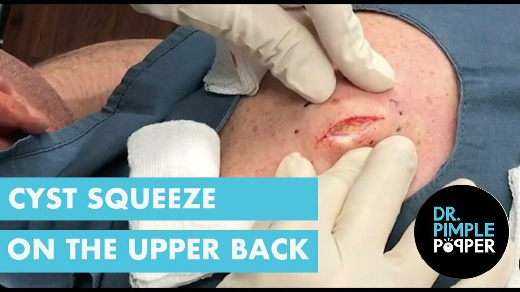 Upper Back Cheese 1