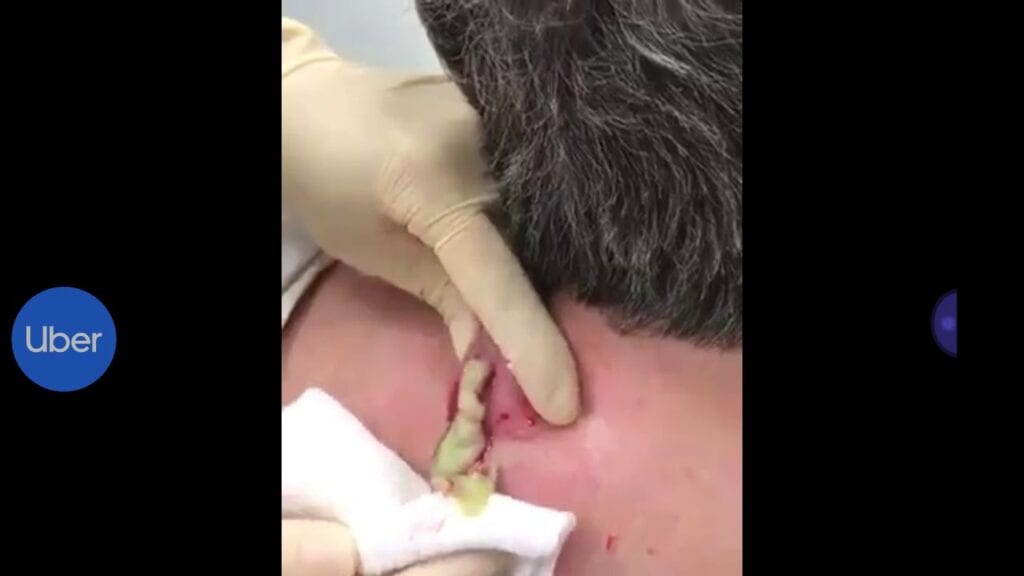 Back Cyst Explosion 1