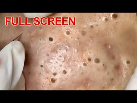 Blackheads Galore 1